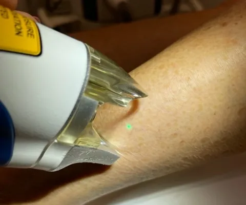 L’importance d’une séance d’entretien par an de laser vasculaire pour vos varicosités